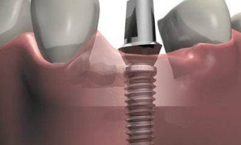 Dantų implantavimas