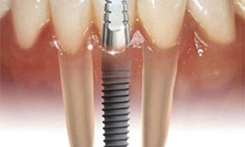 Dantų implantai