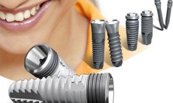 Dantų implantavimas