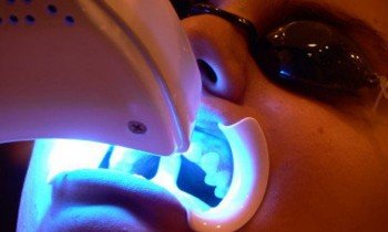 Dantų balinimas lazeriu