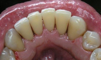 Dantų apnašos - akmenys