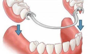 Nuimami dantų protezai